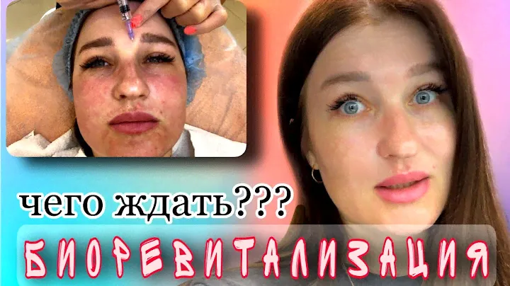 Биоревитализация лица💉/ До и После/ Уколы красоты/ Омоложение/ #биоревитализация#косметология